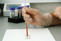 Exame de sangue pode detectar câncer