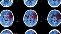 Vírus da herpes associado ao mal de Alzheimer