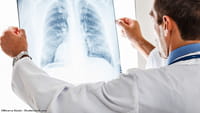 Colar de remédios pode tratar tuberculose
