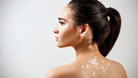 Novo tratamento elimina manchas do vitiligo