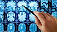 Surge vacina para tratar câncer cerebral