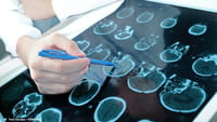 Marcapasso cerebral pode tratar neuropatias